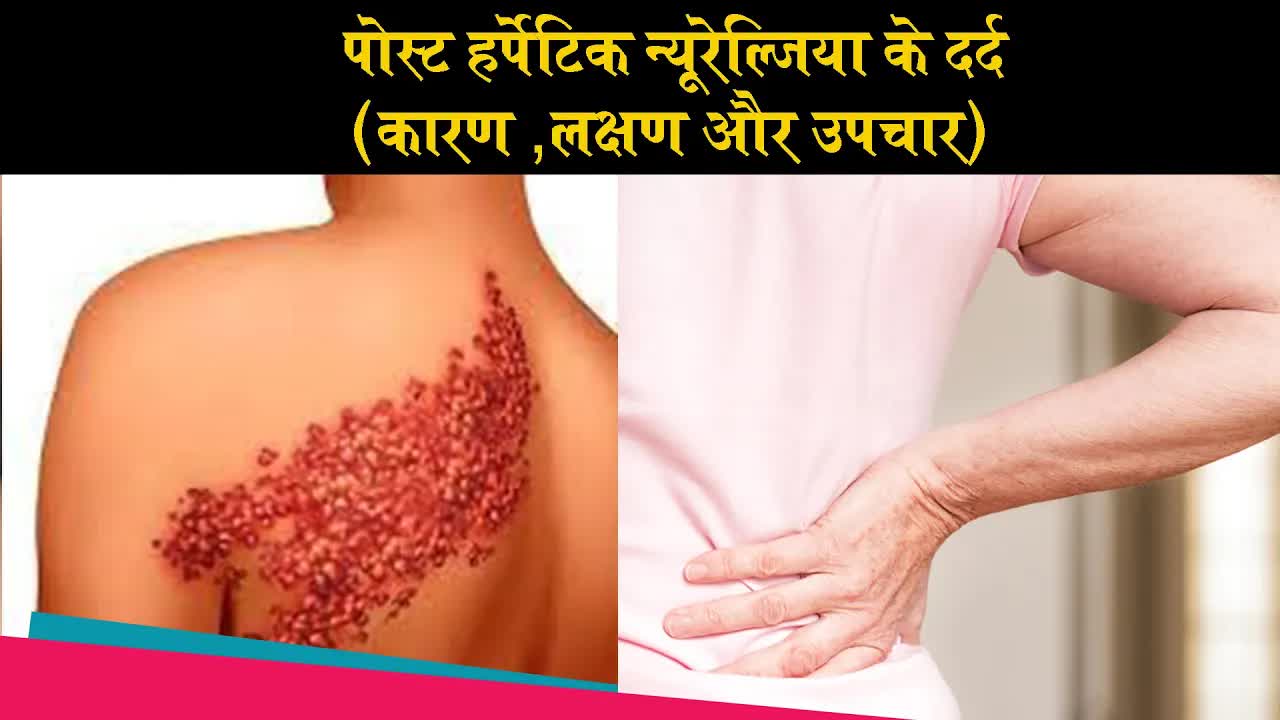 पोस्ट हर्पेटिक न्यूरेल्जिया के दर्द (कारण लक्षण और उपचार ) Dr Amod Manocha